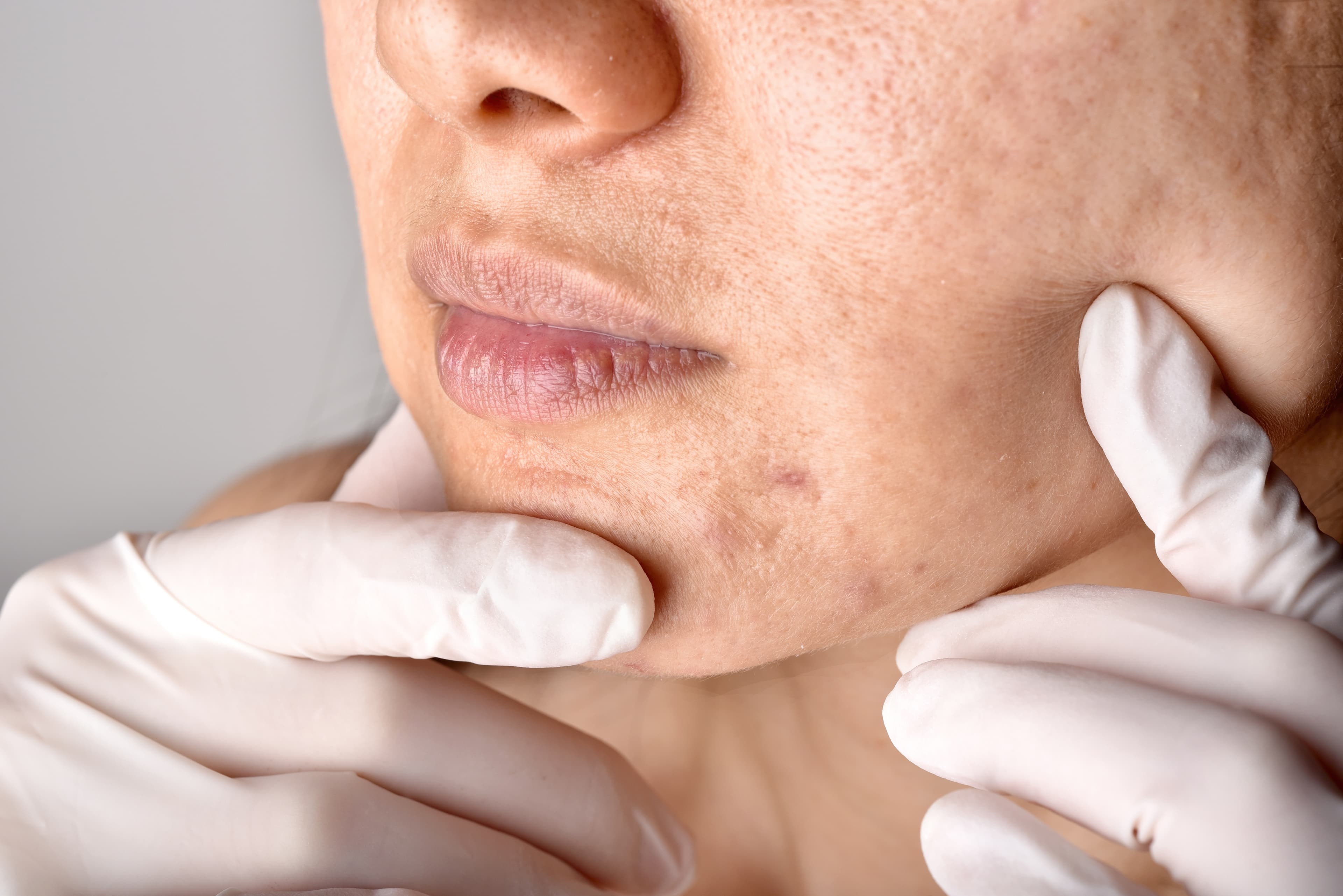 Acne Scars Treatment