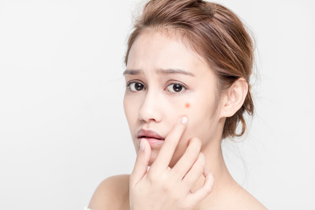 Acne Treatment