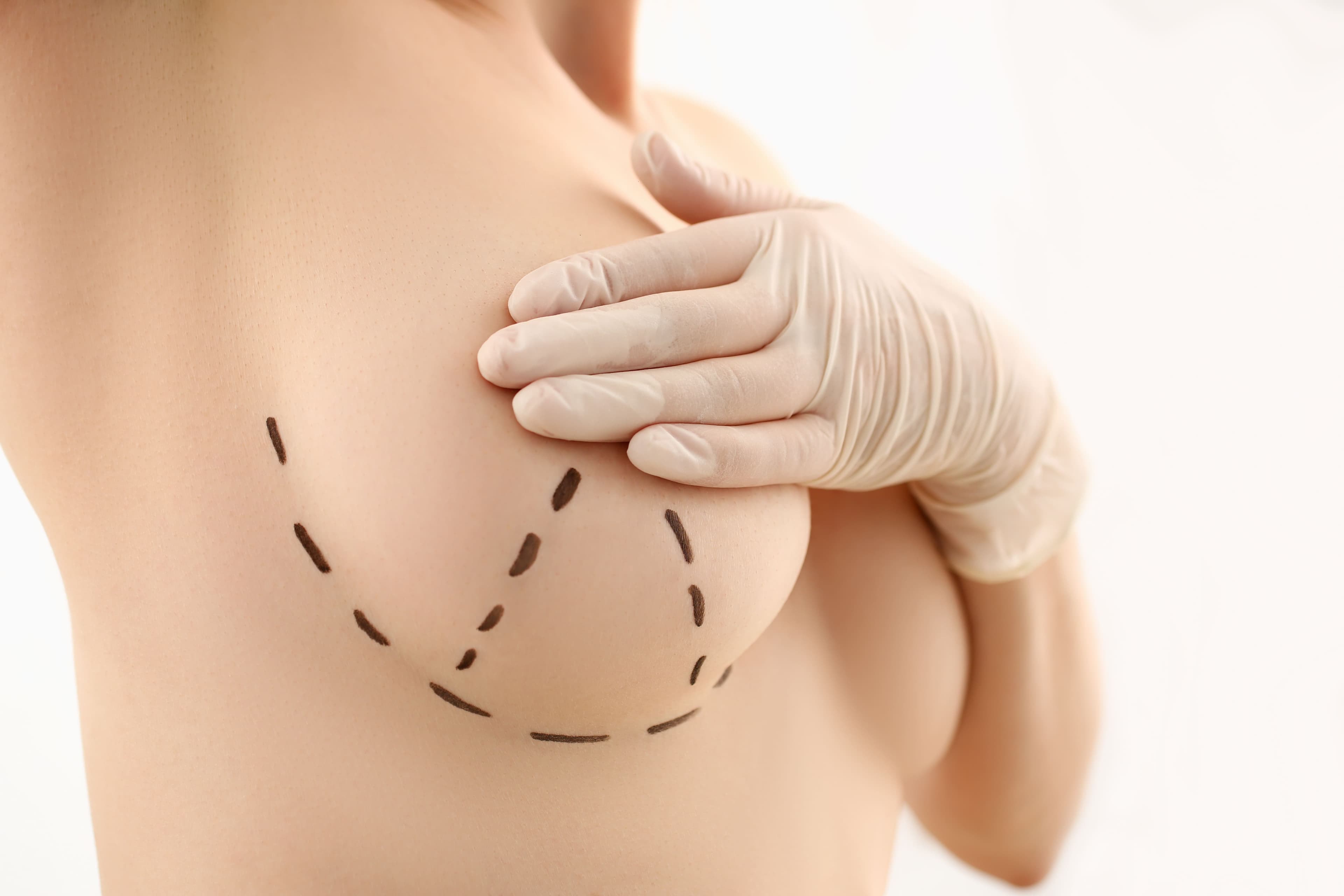 Breast Revision