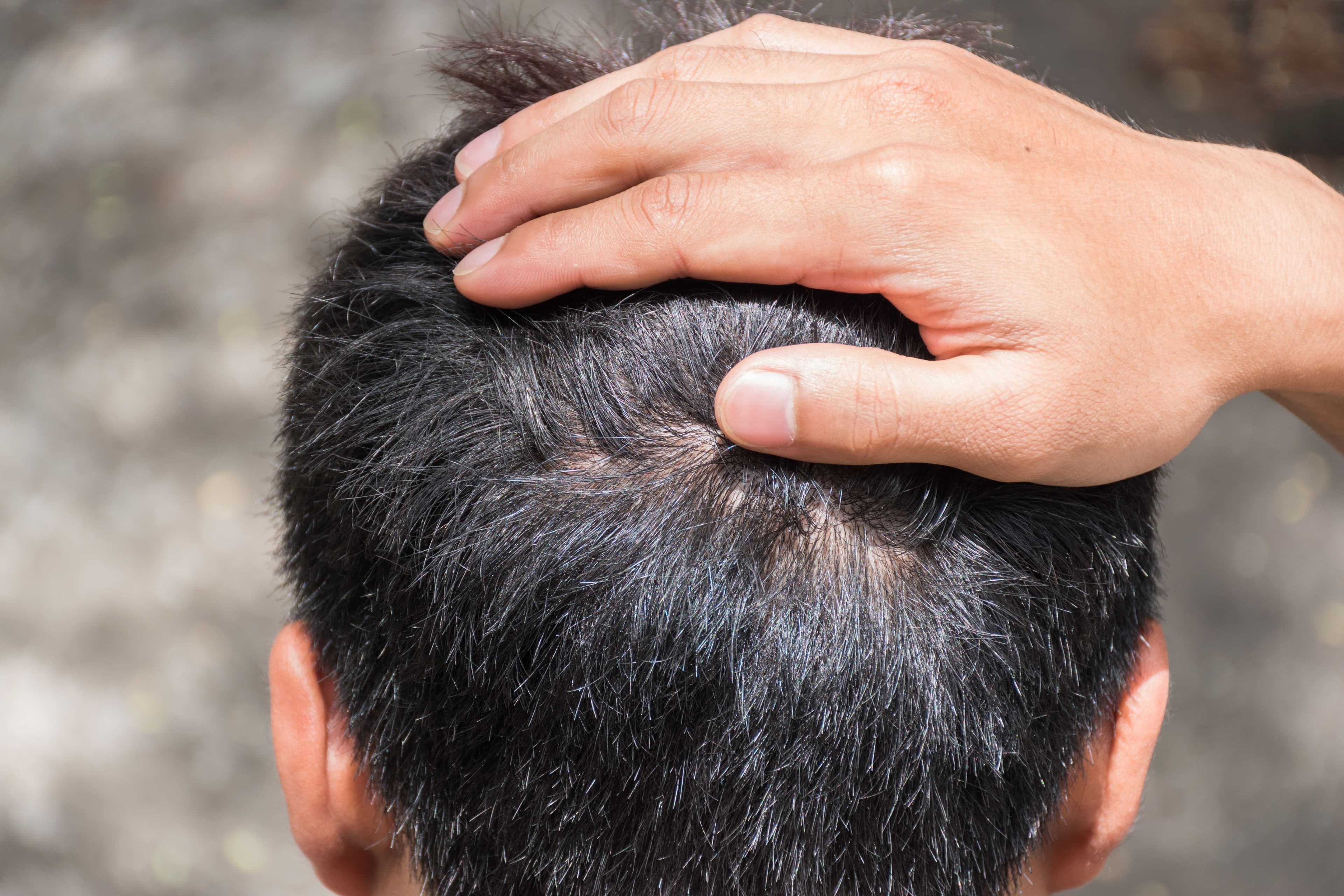 Hair Restoration