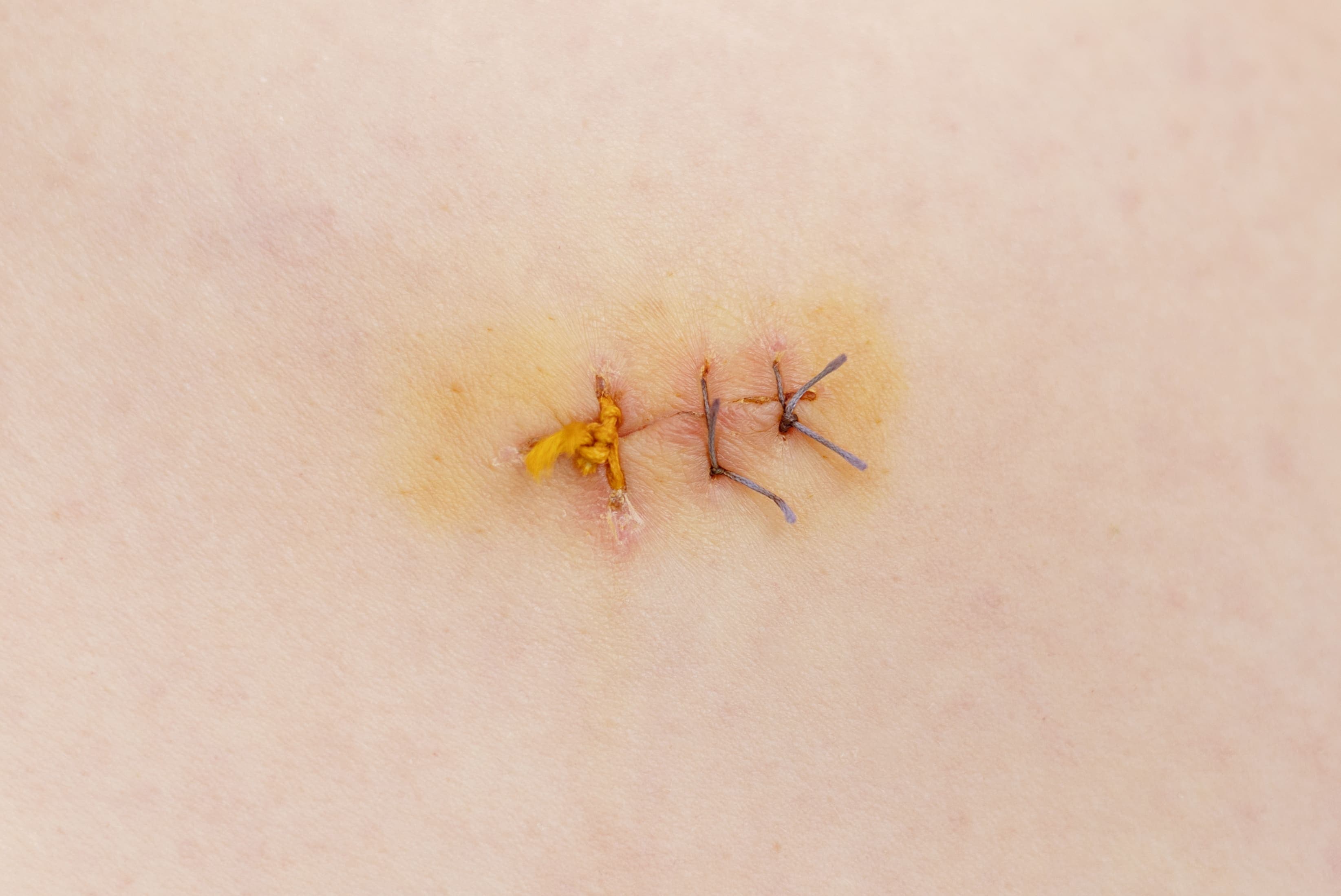 Laceration Repair