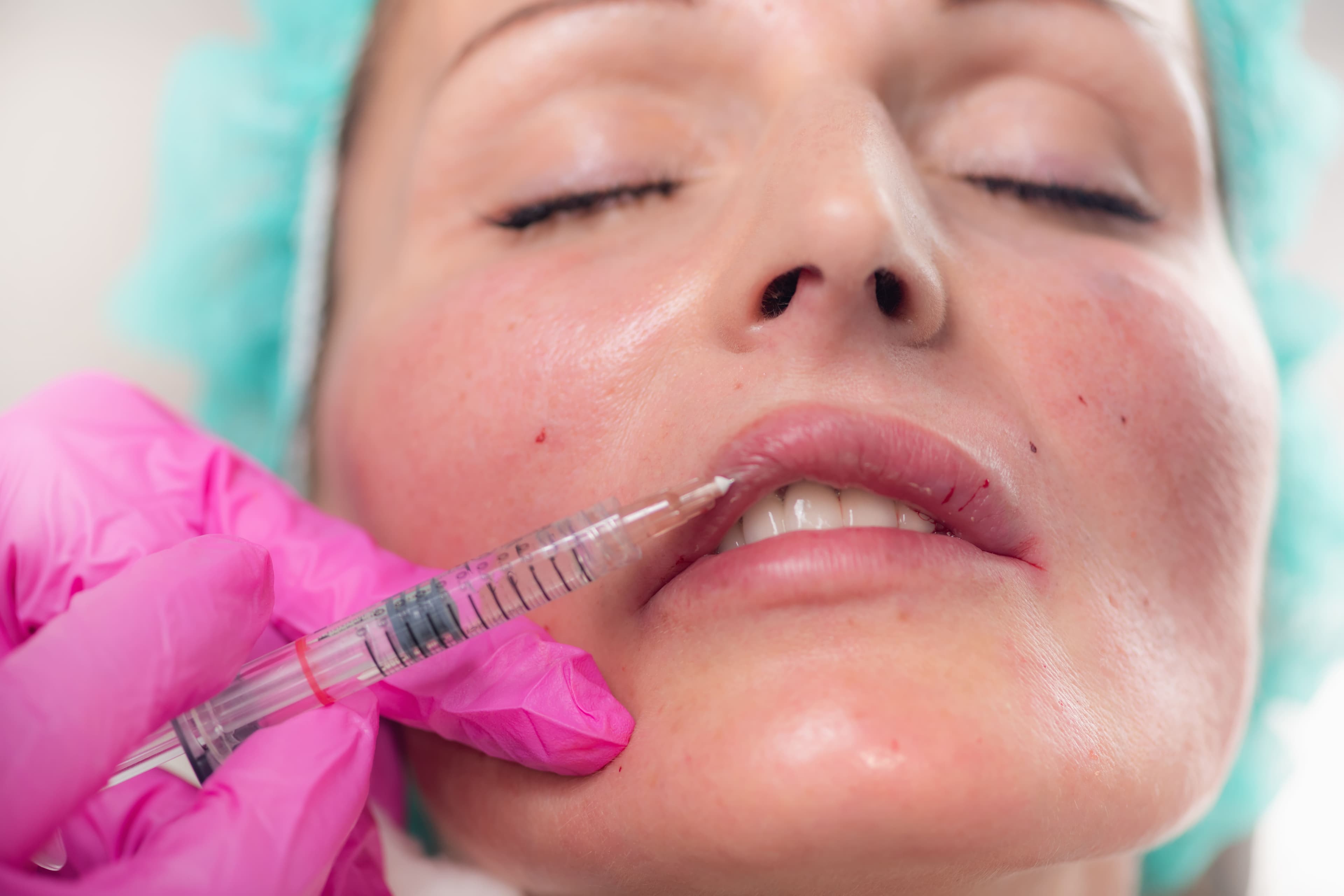 Lip Augmentation