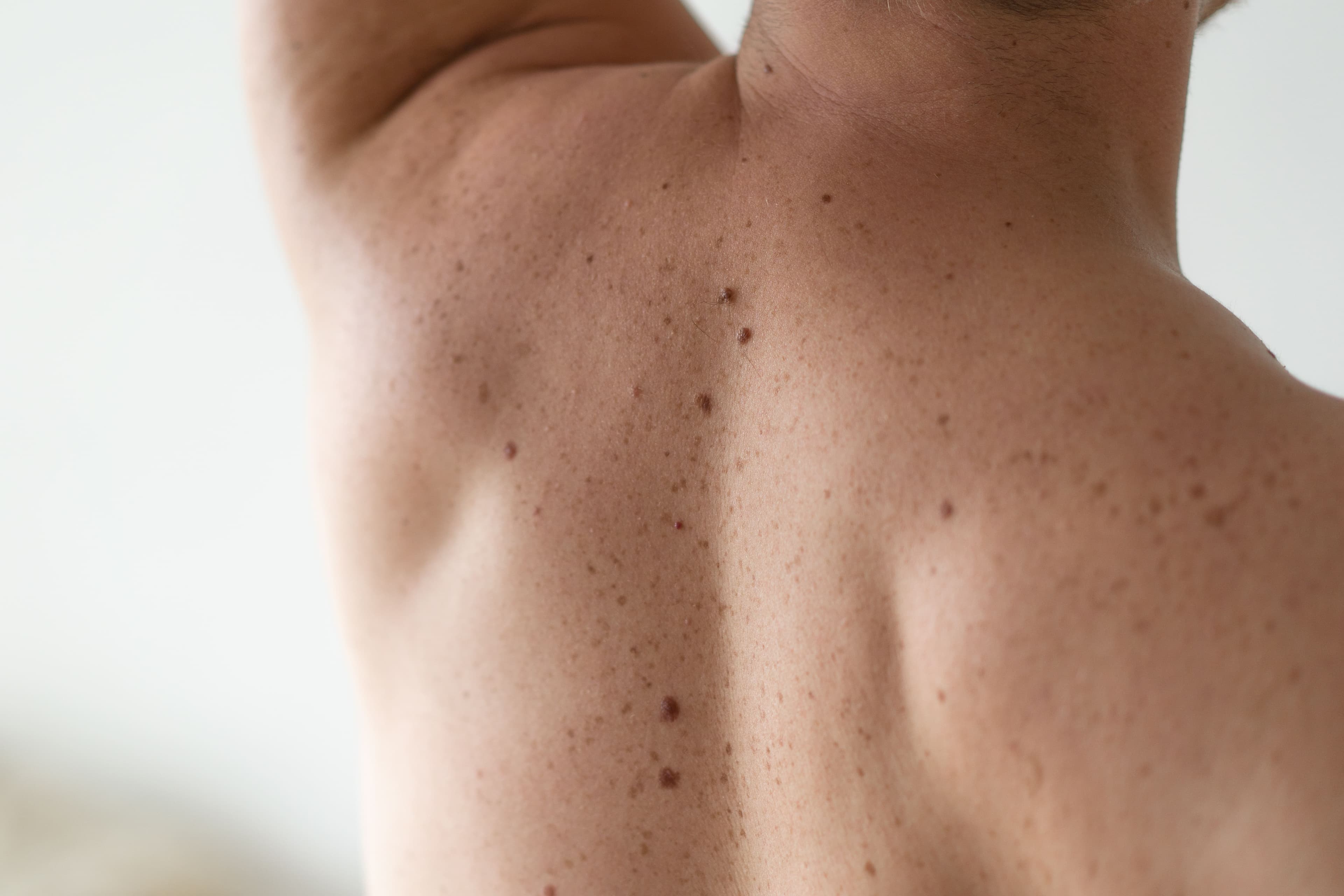 Skin Tag Removal