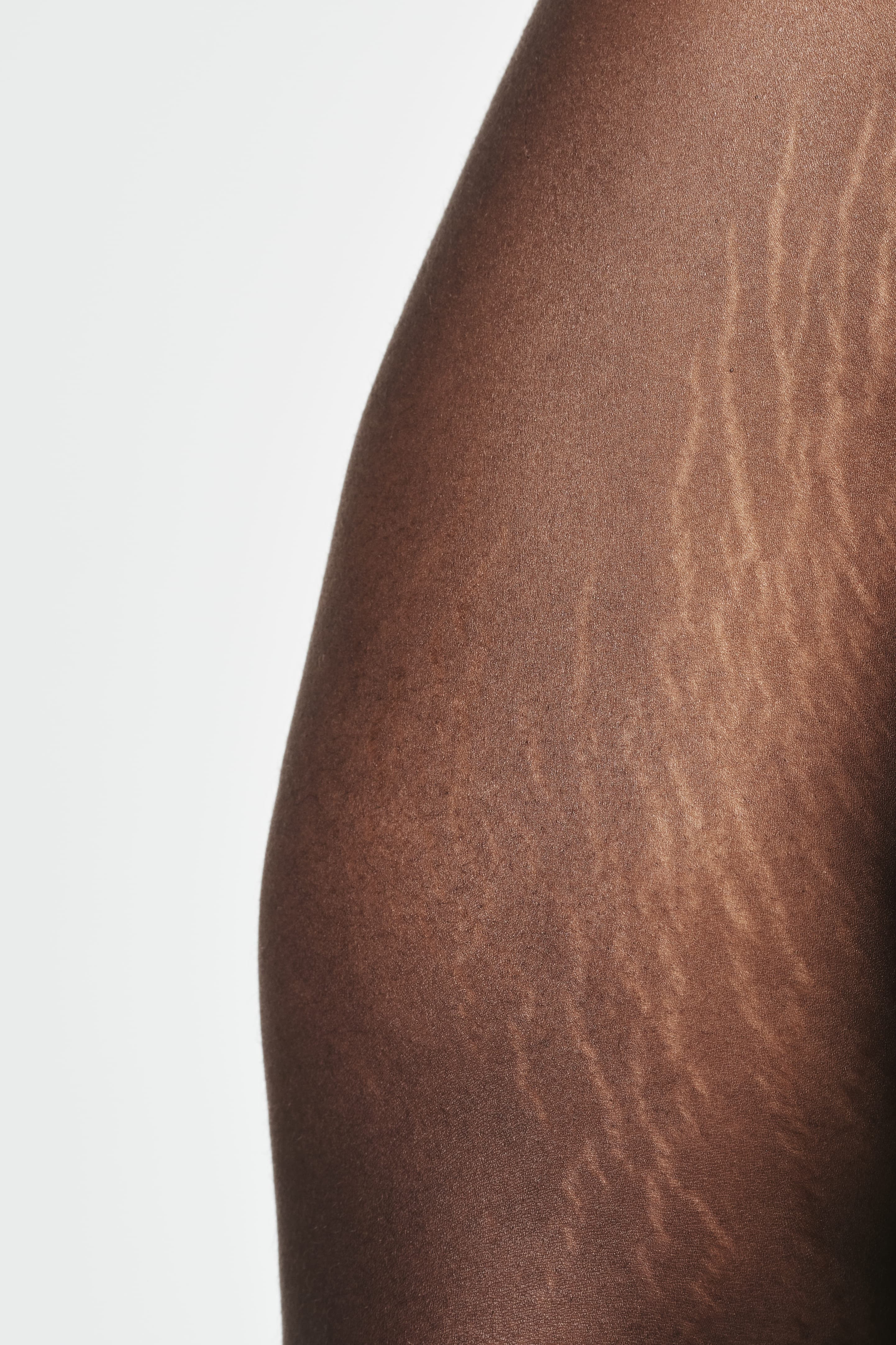 Stretch Marks Treatment