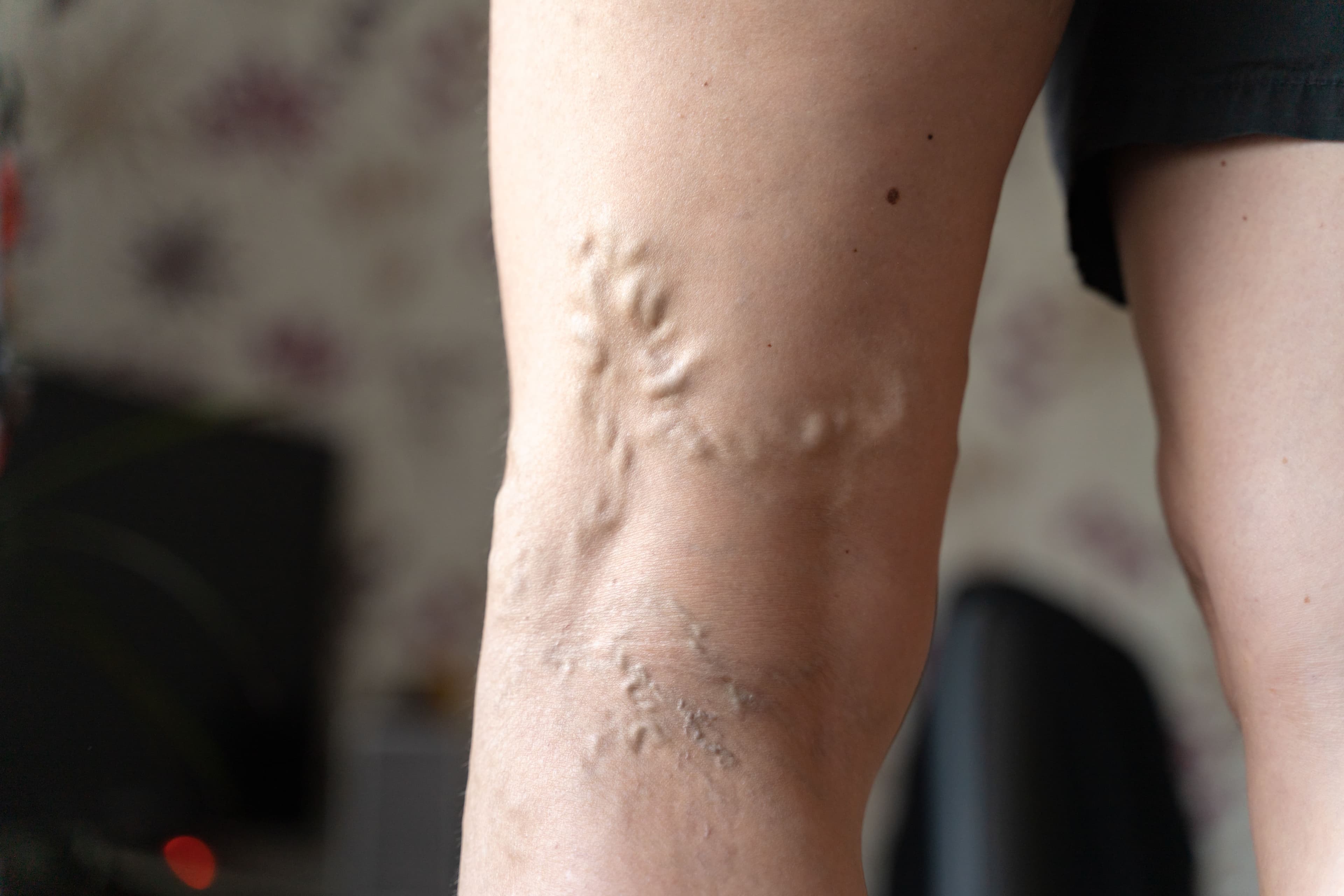 Varicose Vein Treatment